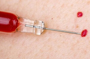 лечение ангиомы