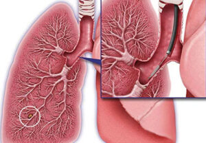 Лечение рака легких в Израиле