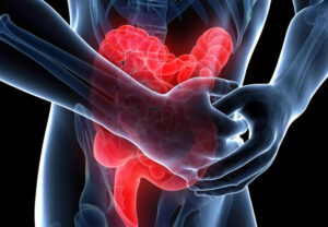 Лечение мезентериальной ишемии в Израиле