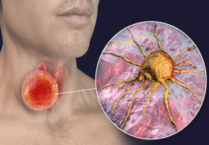 Рак гортани