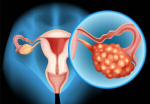 Рак яичников