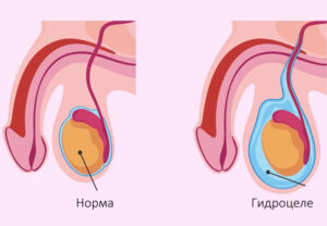 Лечение гидроцеле