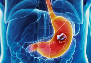 рак желудка