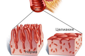 целиакия