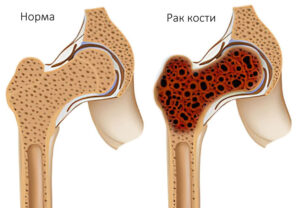рак костей