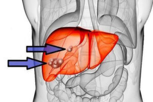 эхинококкоз