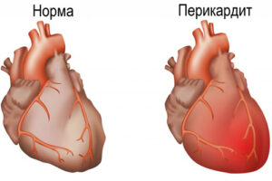 перикардит