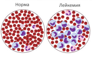 лейкемия