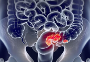 Лечение колоректального рака в Израиле