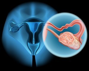 Диагностика гинекологических опухолей в Израиле