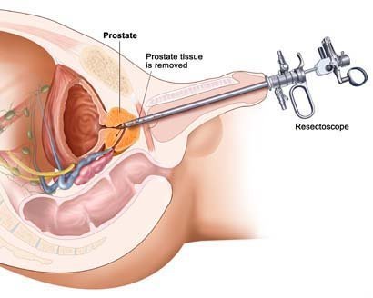 prostate adenoma surgery)