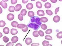 Неходжкинская лимфома