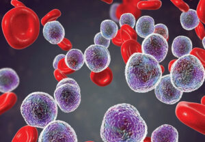 острый лейкоз