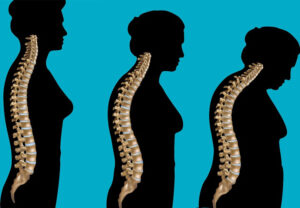 Лечение кифоза в Израиле