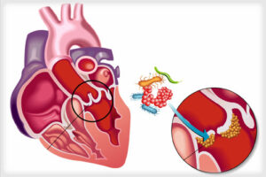 эндокардит