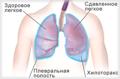 Лечение хилоторакса в Израиле