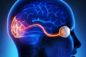 глиома хиазмы