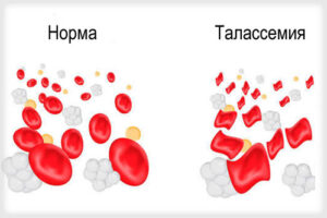 талассемия