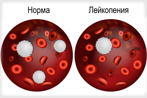 Повышены лейкоциты в моче у ребенка