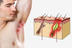 гидраденит