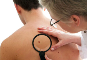 Лечение ангиосаркомы