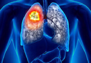 лимфома легкого