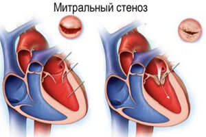 митральный стеноз