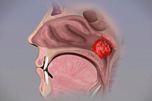 киста Торнвальда
