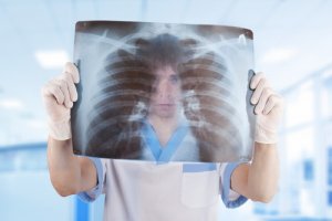 Диагностика опухоли средостения в Израиле