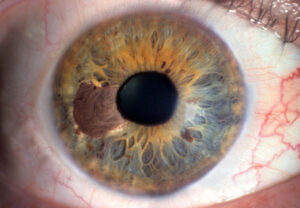 Лечение опухолей глаз в Израиле