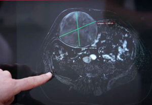 Лечение десмоида в Израиле